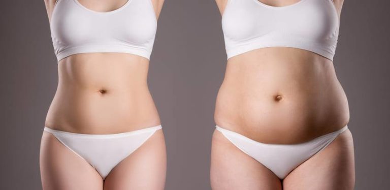 Abdominoplastie Tunisie Retrouvez un Ventre Tonique et Redessiné