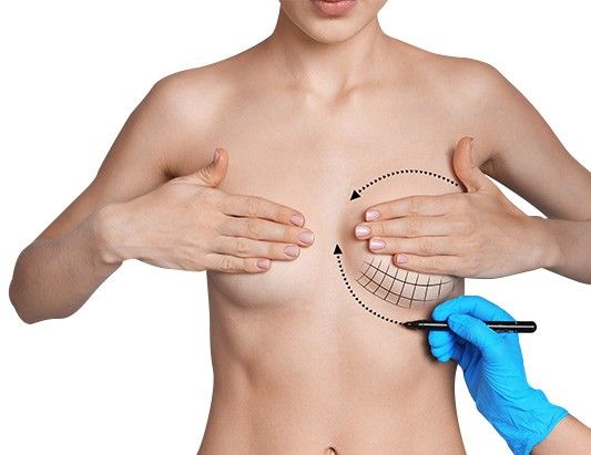 Tourisme médical chirurgie esthétique Tunisie - Lifting mammaire