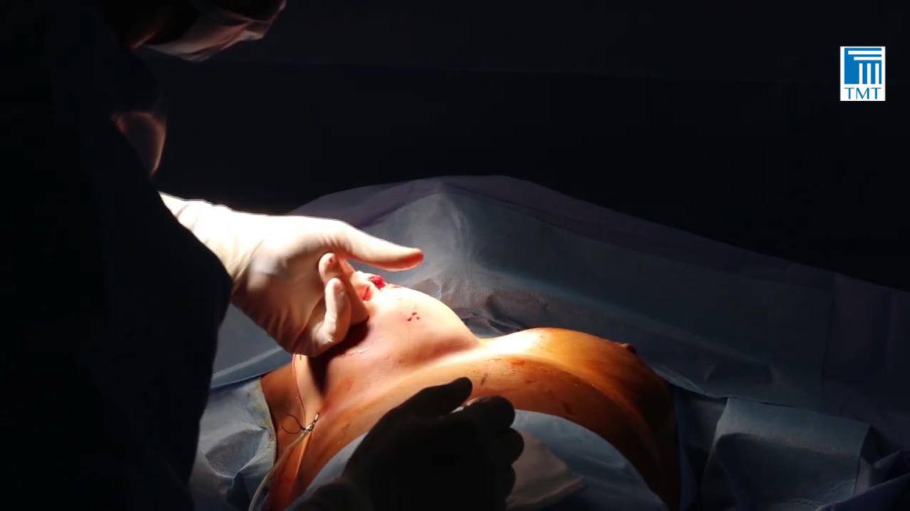 chirurigie des seins - augmentation mammaire par prothese tunisie