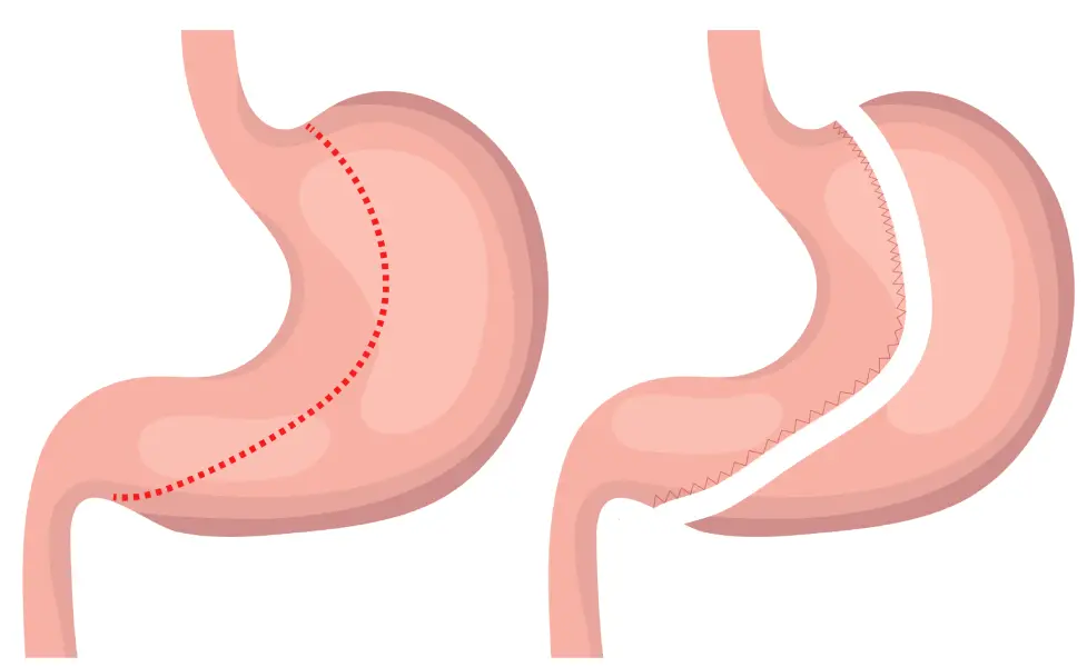 La sleeve gastrectomie, comment ça fonctionne - sleeve tunisie